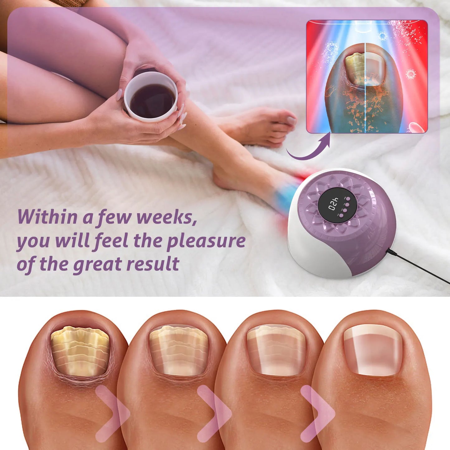 20W Nail Fungus Laser Therapy Device Intelligent Sensor&Digital Display 42pcs*650nm+15pcs*470nm Nail Fungus Remover Nail Care