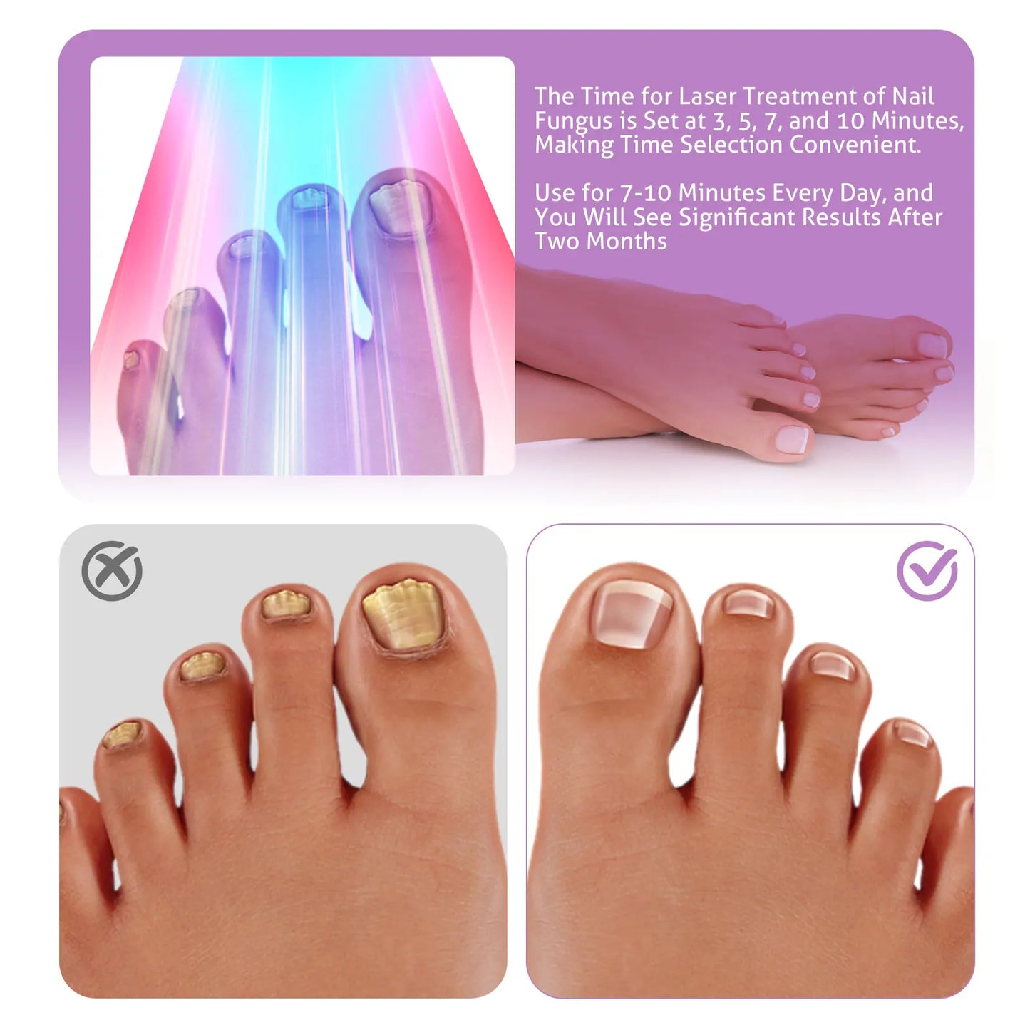 20W Nail Fungus Laser Therapy Device Intelligent Sensor&Digital Display 42pcs*650nm+15pcs*470nm Nail Fungus Remover Nail Care